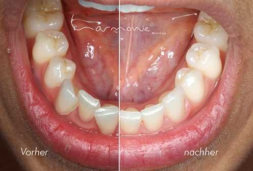 Vorher und Nachher Bilder der Alignertherapie mit der Harmonieschiene